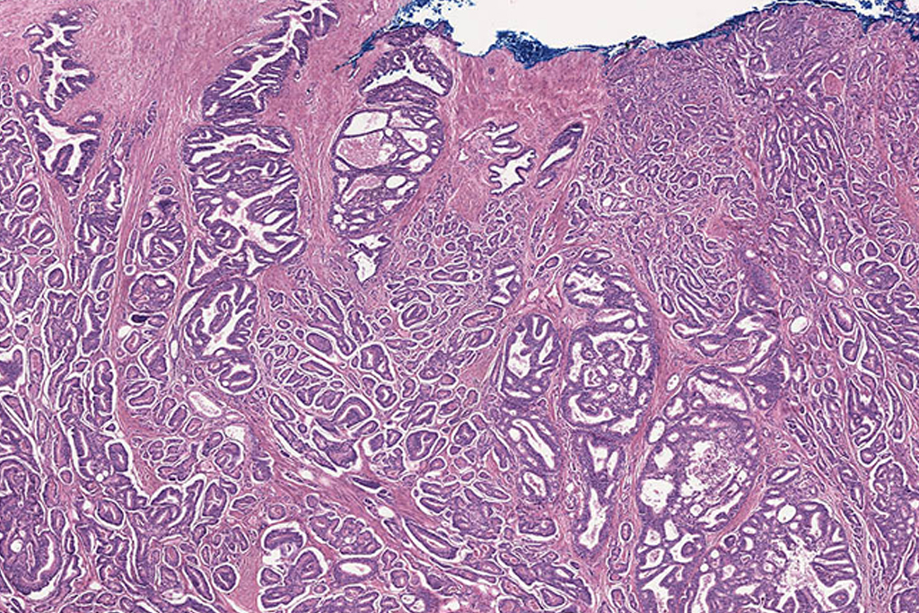 Microscopy picture on prostate cancer