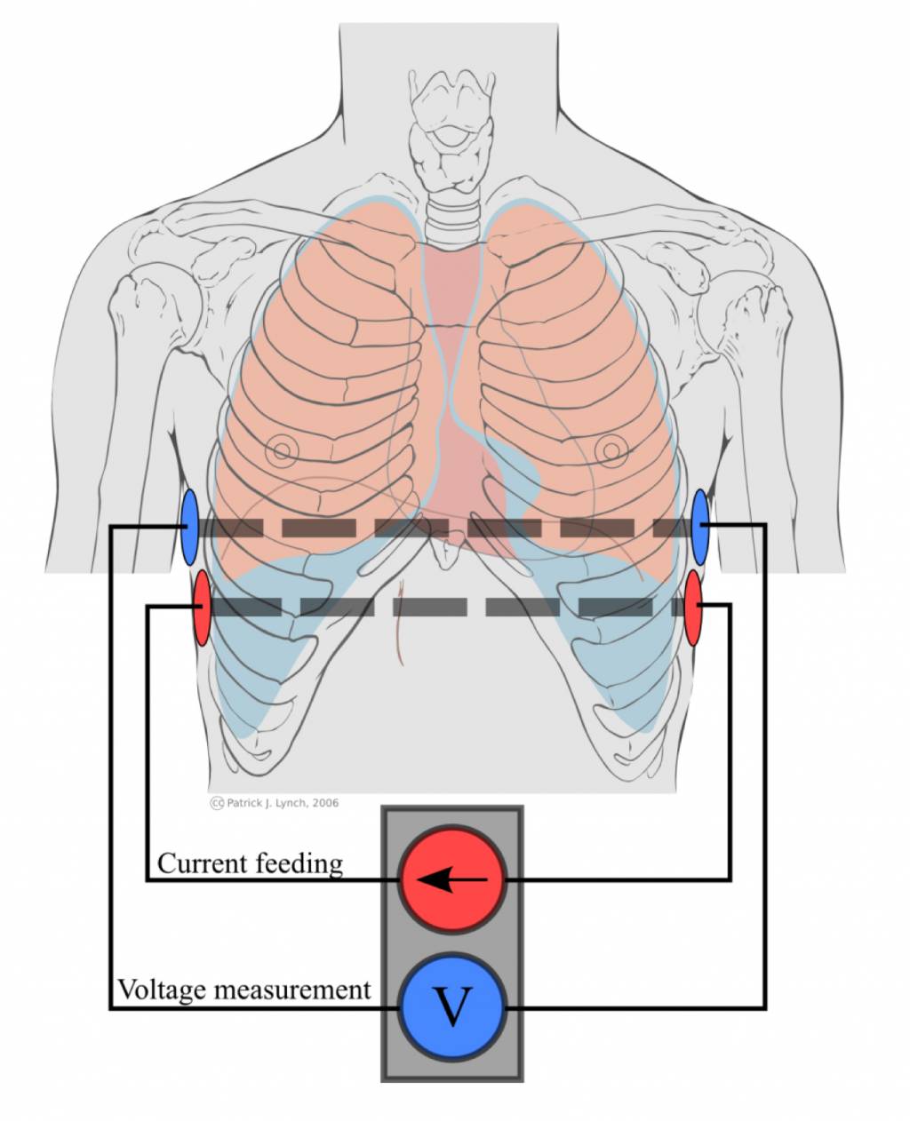 Pulmonary ventilation by impedance pneumography