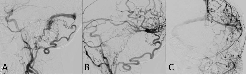 Example of a DAVF that progressed despite radiotherapy