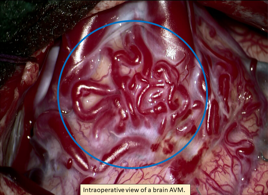 An arteriovenous malformation