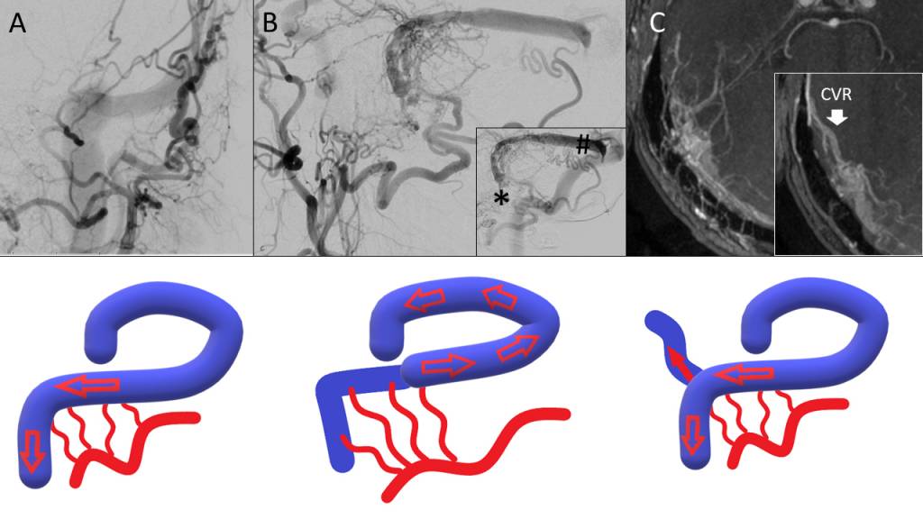 Digital substraction angiography (DSA) examples 