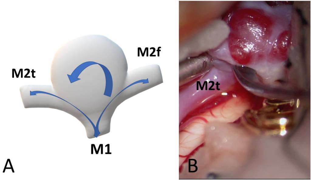 A typical saccular aneurysm