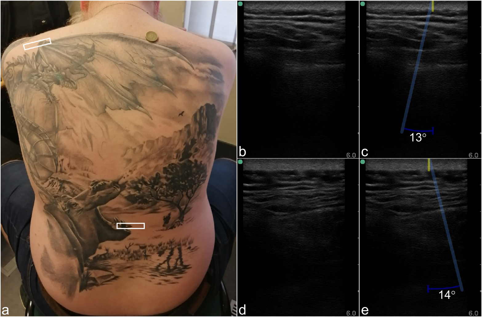Ultrasound images of a back tattoo.