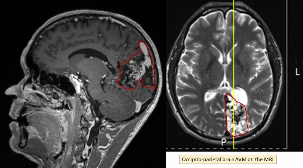 An arteriovenous malformation in MRI