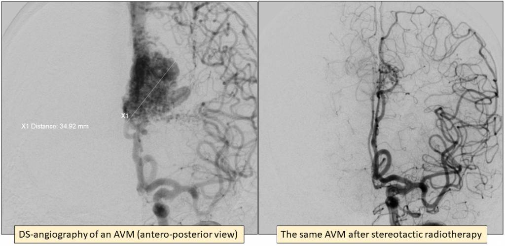 The angiographic presentation of an arteriovenous malformation