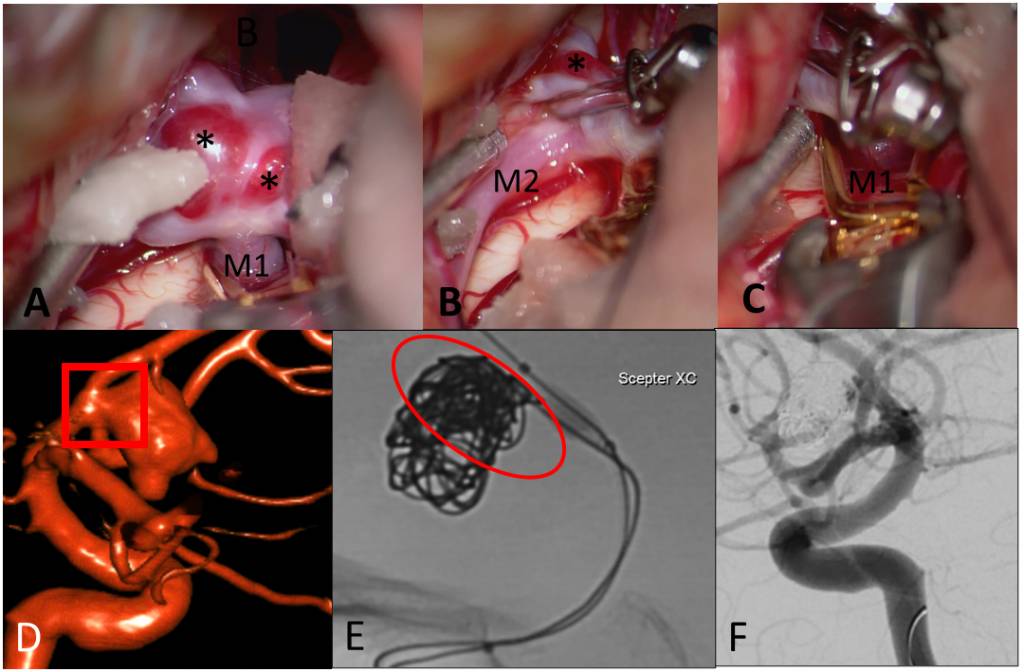 steps of microsurgical clipping an aneurysm